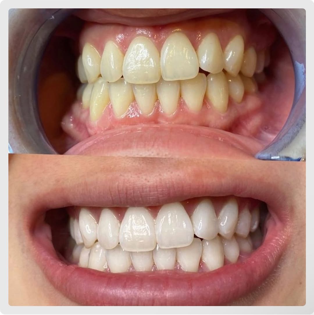 Lentes de Contato Dental